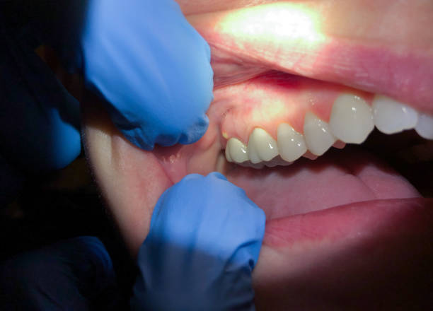 Best Emergency Dentist for Knocked-Out Tooth in Shawneetown, IL